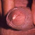 Augmentation des infections sexuelles dues aux gonocoques - 